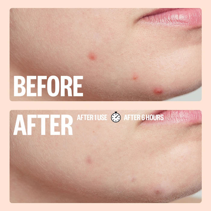 Salicylic Acid Acne Healing Dots